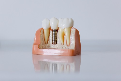 5 Ways Of composite fillings That Can Drive You Bankrupt - Fast!